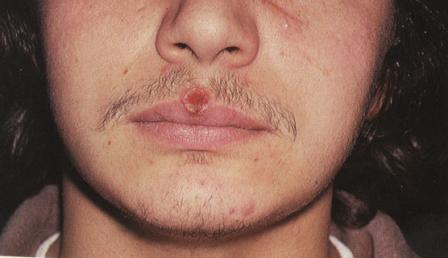 сифилис первичный, локализация твердого шанкра на губе